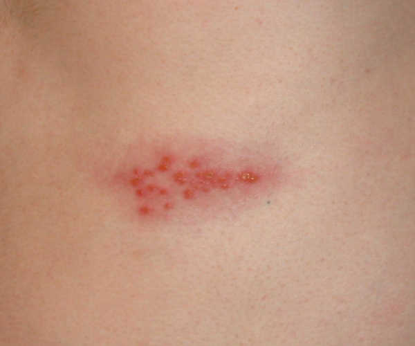 Gürtelrose Herpes Zoster