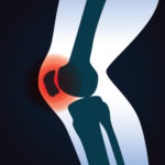 Innenbanddehnung im Knie - Symptome und Behandlung