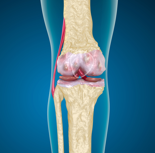 Knochenmarködem im Knie - Therapie und Symptome