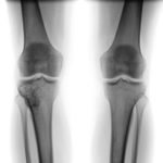 Tumor im Kniegelenk - Therapie und Symptome