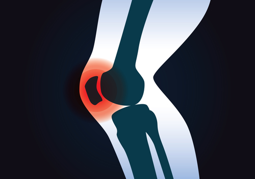 Dickes Knie - Ursachen, Therapie und Behandlung