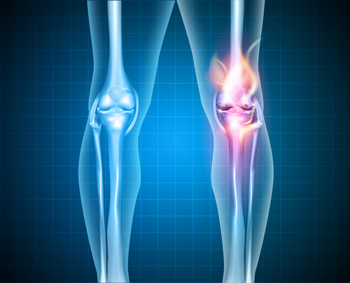 Knirschen im Knie - Ursachen und Therapie
