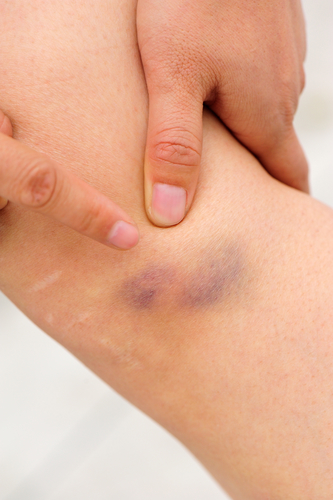 Knie geprellt - Symptome, Therapie bei Knieprellung