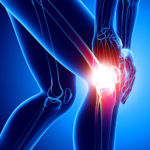 Überbelastung Knie - Therapie, Symptome, Ursachen und Folgen