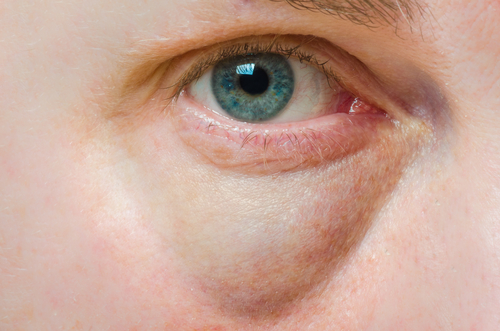 Geschwollenes Augenlid - Ursachen und Therapie