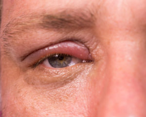 Augenlidentzündung – Dauer der Heilung und Entzündungsformen