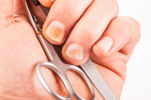 Gelbe Fingernägel – Ursachen und Behandlung