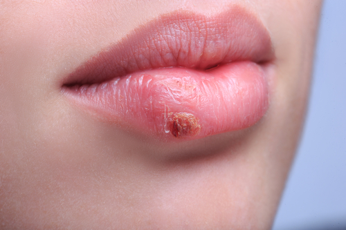 Geschwollene Lippen – Ursachen und Therapie