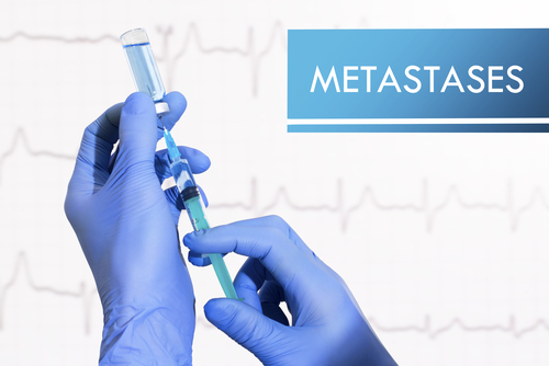 Lebenserwartungen bei Ossäre Metastasen