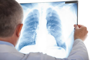 Rundherd Lunge – ist das gefährlich?