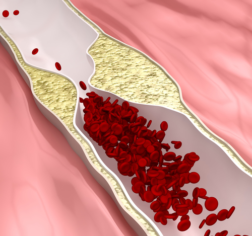 Vasosklerose – ist wirklich gefährlich?