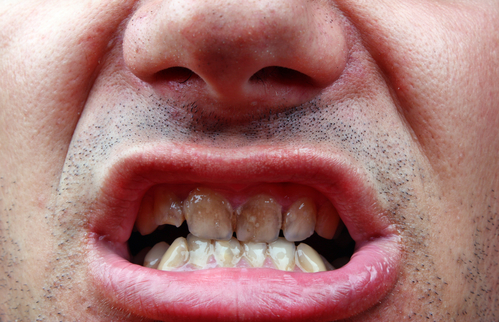 Weiße Flecken auf den Zähnen – Ursachen dafür