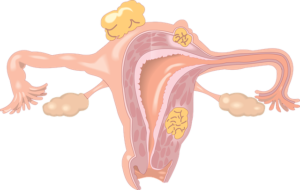 Polypen in Gebärmutter – Ursachen, Symptome und Behandlung