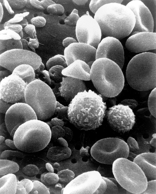 Antiphospholipidsyndrom – Ursachen, Symptome und Behandlung