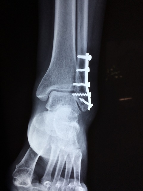 Pilon Tibiale – Ursachen, Behandlung und Therapie