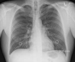 Lungenpest – Symptome, Diagnose und Behandlung