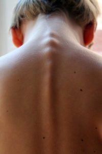 Rückenmarkspunktion – Gründe, Ablauf und mögliche Komplikationen