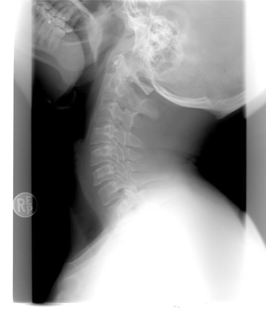 Schleudertrauma – Symptome, Dauer und Therapieansatz