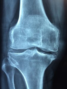 Kniedistorsion – Definition, Symptome und Behandlung