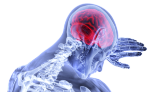 Blutgerinnsel im Kopf – Ursachen, Symptome und Diagnose