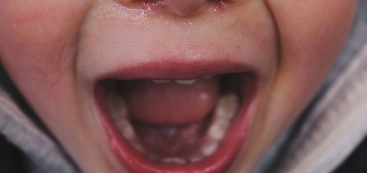 Eine Mundentzündung kann große Schmerzen verursachen