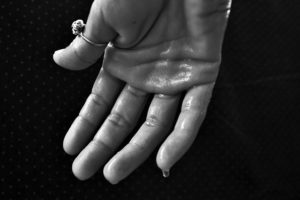 Schwitzende Hände – Ursachen, Behandlung und wirkende Mittel