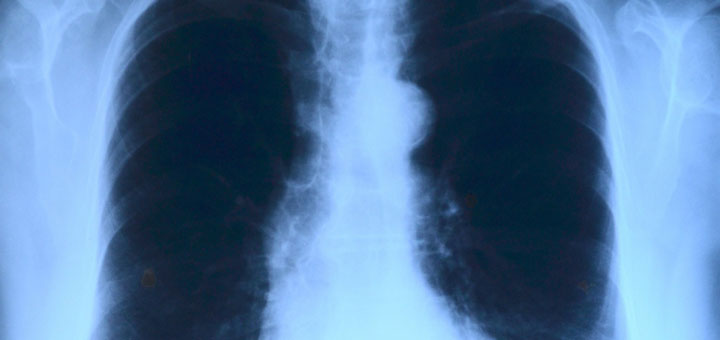 Röntgenbild einer Thoraxprellung